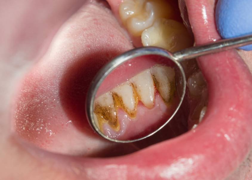 How to Remove Tartar from Teeth without Dentist